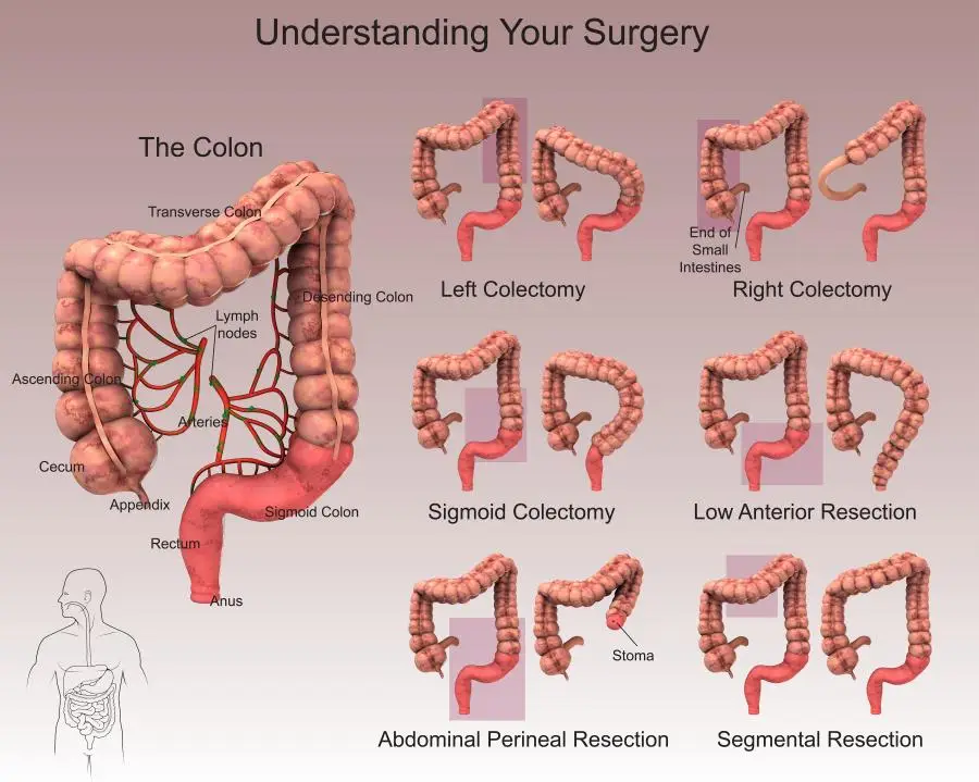 Colorectal Surgery